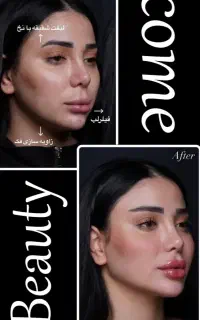 لیزر موهای زائد هایفو لاغری کربن تراپی ریمو تتو
