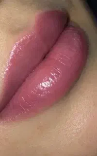 تزریق لب خط خنده گونه چانه سی سی 990پیرسینگ کل بدن