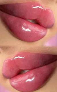 ژل لب-فیلر لب-بوتاکس(فیلر لب روسی)