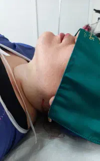 ساکشن لیپوماتیک غبغب شکم پهلو تزریق چربی