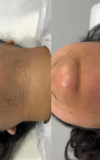 لیزرموهای زائد در۶جلسه
