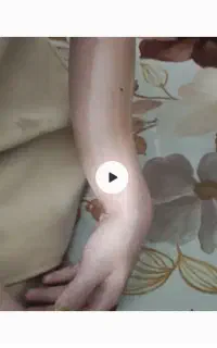 شکسته بندی