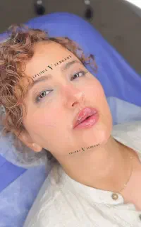 فیلر لب بادی ژل کانتور صورت بوتاکس مزو تزریق چربی