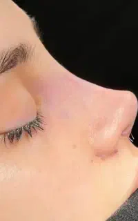 جراحی زیبایی بینی و مشاوره تخصصی