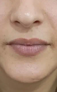 تزریق فیلروبوتاکس هزینه مواد