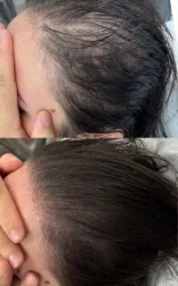 احیای حرفه‌ای مو