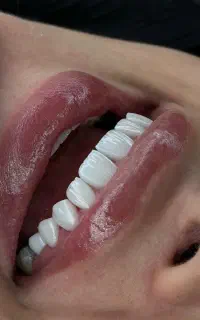 ونیر لبه شفاف،اوردنچر،لمینیت