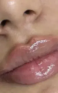 تزریق ژل و بوتاکس
