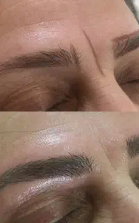 میکروبلیدینگ