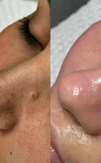 پاکسازی تخصصی پوست و میکرو ابرو