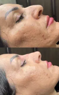 تغییر طبیعی ژل فیلر بوتاکس
