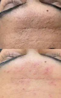 تخفیف ویژه فشیال(پاکسازی پوست)