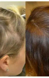 با موهای کم خدافظی کن