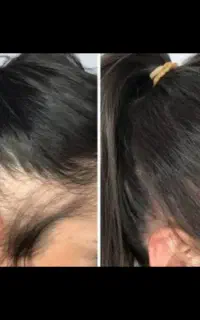 میکرواسکالپ جایگزین کاشت مو