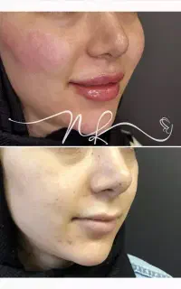 بوتاکس/فیلر صورت/کلینیک فرسیما/بوتاکس/نخ