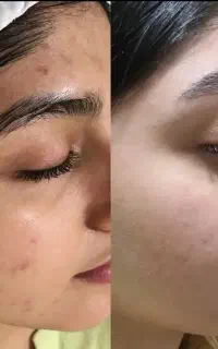 پاکسازی و فشیال صورت ،تخصصی با دستگاه