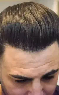 کاشت مو و ابرو prp فوق حرفه ای