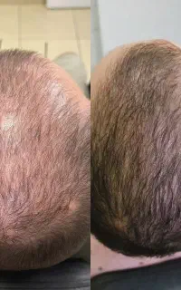 سلامت دوباره مو