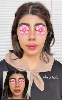 فیلر بوتاکس مزوتراپی پیرسینگ توسط پزشک