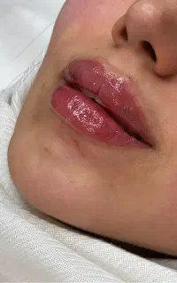 بوتاکس مصپورت فقط۴۹۰ کلینیک زیبایی دکتر فرشیدکریمی