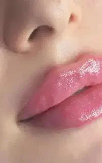 نیازمندمدل ژل وبوتاکس
