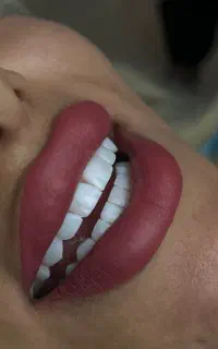 کامپوزیت فکی ۴/۵۰۰ به مدت یک هفته