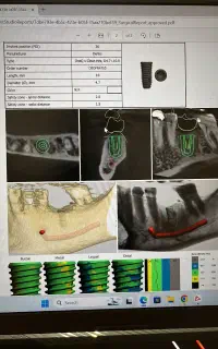 ایمپلنت دیجیتال