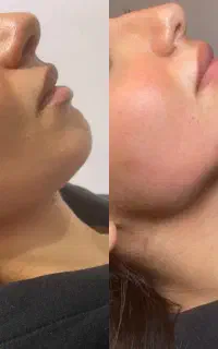 مدل ژل و بوتاکس مدل ژل