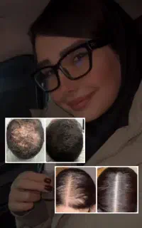 رویش مجدد ریش و مو