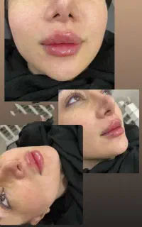 تزریق ژل وبوتاکس مزو ژل پی ارپی توسط پزشک (کلینیک)