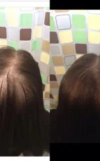 پرونده PRP رو برای همیشه ببند