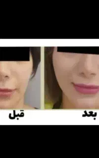 پک چاقی صورت
