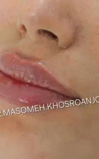 آف فیلر لب هر سی سی فقط ۳ میلیون تزریق توسط پزشک