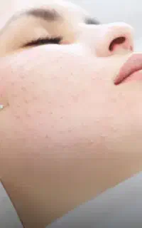 تخفیف پی آرپی ومزوتراپی توسط پزشک