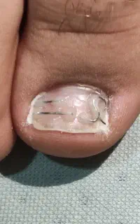 آموزش ناخن تو گوشت و ناخن قارچی و پدیکور اسپا