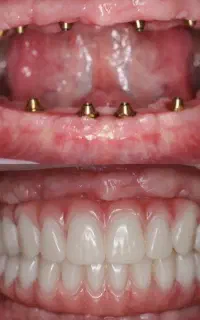 دندان پرشکی ایمپلنت اوردنچر دو فک(اقساطی)