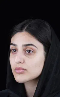 عمل بینی حرفه‌ای با تکنیک روز دنیا /شیراز/اقساط