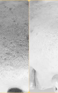 جمع کردن منافذ و کم عمق کردن اسکار جوش