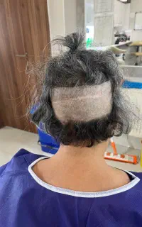 کاشت مو ابرو ریش تخصصی