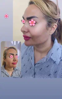 ژل لب (فیلر) و بوتاکس صورت