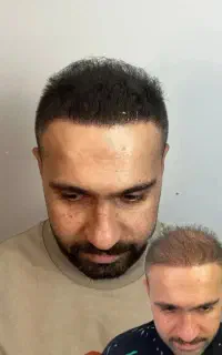 میکرواسکالپ پرپشتی مو تضمینی در کلینیک پوست ومو
