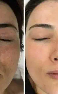 روغن زد لک بوتاکس طبیعی پوست