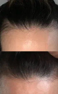 جایگزین کاشت مو اومد