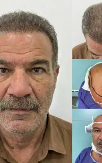 نژا کاشت مجموعه تخصصی کاشت مو و ابرو از سال 1383