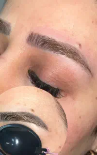 پاک کردن تتو با دستگاه لیزر