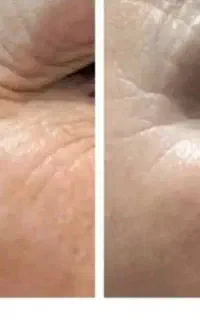 جدیدترین روش جوانسازی و رفع چروک