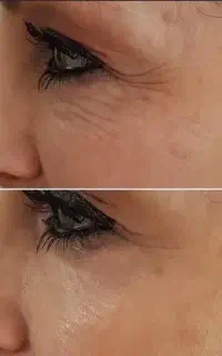 درمان چین و چروک،شل و افتادگی پوست صورت،لک