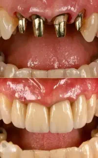 ایمپلنت دیجیتالی یک روزه با چک