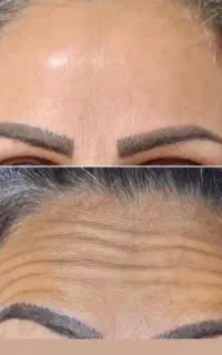 تزریق ژل و بوتاکس  کلیه خدمات پوستی   قیمت مناسب