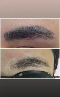 پاک کردن تتو۵۰۰/لیزر موهای زائد/الکترولیز/فیشیال